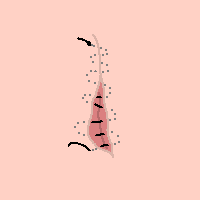 Image of subcuticular suture pattern